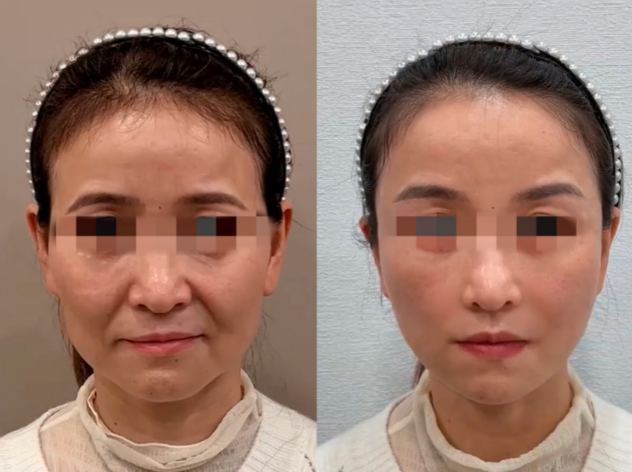 濟南王召東筋膜提升技術怎么樣？
