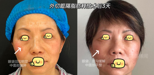 上海九院高博聞做祛眼袋技術(shù)怎么樣？