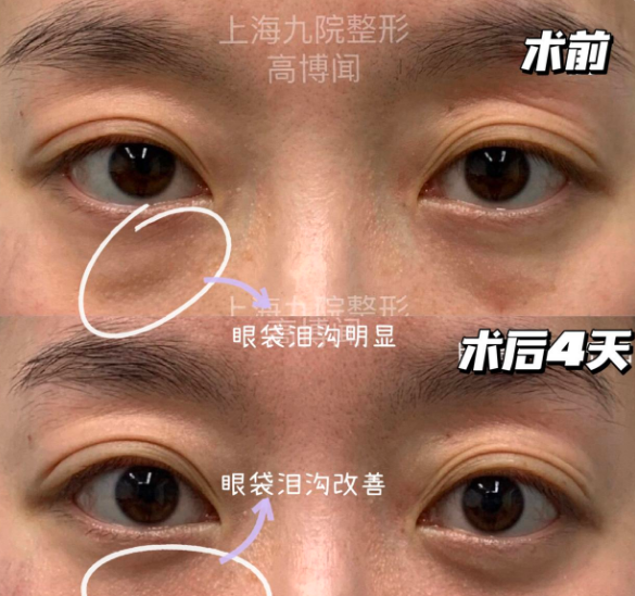 高博聞祛眼袋案例