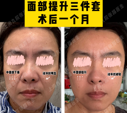 上海九院張路面部提升三件套多少錢