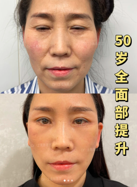 上海陳建忠做拉皮技術怎么樣？