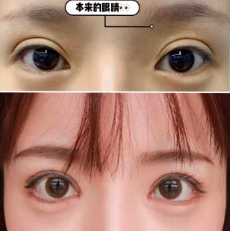 杭州雙眼皮修復醫(yī)生排名哪個最好？