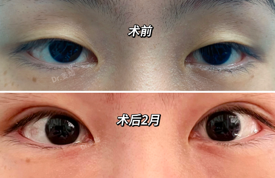 姜燦做雙眼皮案例